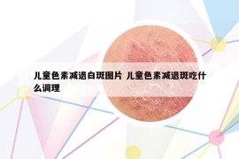 兒童色素減退白斑圖片 兒童色素減退斑吃什么調(diào)理
