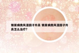 銀屑病類(lèi)風(fēng)濕因子升高 銀屑病類(lèi)風(fēng)濕因子升高怎么治療?