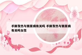 手腳發(fā)熱與銀屑病有關(guān)嗎 手腳發(fā)熱與銀屑病有關(guān)嗎女性