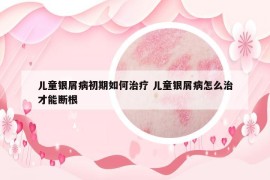 兒童銀屑病初期如何治療 兒童銀屑病怎么治才能斷根