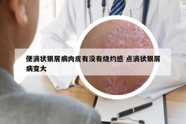 便滴狀銀屑病肉皮有沒有燒灼感 點(diǎn)滴狀銀屑病變大
