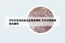 艾葉紅花泡水能治愈銀屑病嗎 艾葉對銀屑病有效果嗎