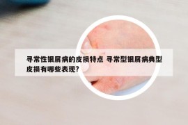 尋常性銀屑病的皮損特點(diǎn) 尋常型銀屑病典型皮損有哪些表現(xiàn)?