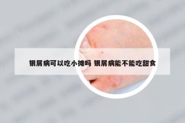 銀屑病可以吃小攤嗎 銀屑病能不能吃甜食