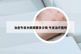 治愈牛皮大概需要多少錢 牛皮治療醫(yī)院