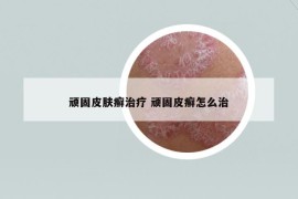 頑固皮膚癬治療 頑固皮癬怎么治