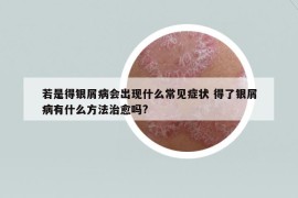 若是得銀屑病會出現(xiàn)什么常見癥狀 得了銀屑病有什么方法治愈嗎?