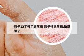 孩子12了得了銀屑病 孩子得銀屑病,快崩潰了