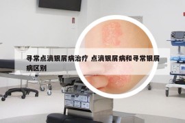 尋常點(diǎn)滴銀屑病治療 點(diǎn)滴銀屑病和尋常銀屑病區(qū)別