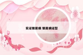 實(shí)證銀屑病 銀屑病證型