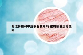 愛(ài)流鼻血和牛皮癬有關(guān)系嗎 銀屑病會(huì)流鼻血嗎