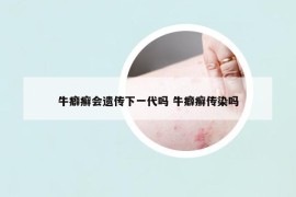 牛癖癬會遺傳下一代嗎 牛癖癬傳染嗎