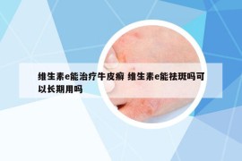 維生素e能治療牛皮癬 維生素e能祛斑嗎可以長期用嗎