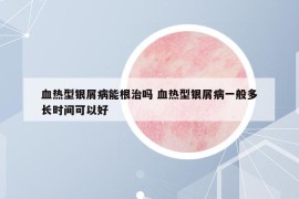 血熱型銀屑病能根治嗎 血熱型銀屑病一般多長時間可以好