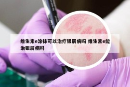 維生素e涂抹可以治療銀屑病嗎 維生素e能治銀屑病嗎