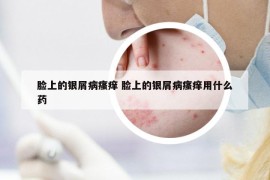 臉上的銀屑病瘙癢 臉上的銀屑病瘙癢用什么藥