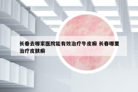 長(zhǎng)春去哪家醫(yī)院能有效治療牛皮癬 長(zhǎng)春哪里治療皮膚癬