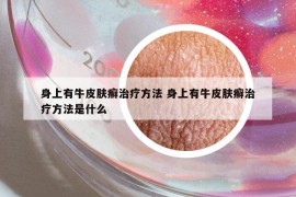 身上有牛皮膚癬治療方法 身上有牛皮膚癬治療方法是什么