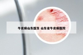 牛皮癬山東醫(yī)生 山東省牛皮癬醫(yī)院