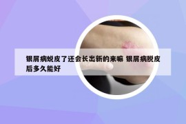 銀屑病蛻皮了還會長出新的來嘛 銀屑病脫皮后多久能好