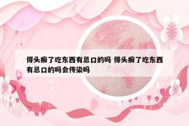 得頭癬了吃東西有忌口的嗎 得頭癬了吃東西有忌口的嗎會傳染嗎