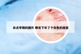 白點(diǎn)早期的圖片 眼皮下長了個白色的痘痘