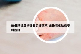 連云港銀屑病哪看的好醫(yī)院 連云港皮膚病?？漆t(yī)院