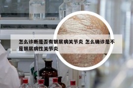怎么診斷是否有銀屑病關(guān)節(jié)炎 怎么確診是不是銀屑病性關(guān)節(jié)炎