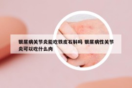 銀屑病關(guān)節(jié)炎能吃鐵皮石斛嗎 銀屑病性關(guān)節(jié)炎可以吃什么肉