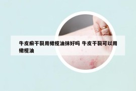 牛皮癬干裂用橄欖油抹好嗎 牛皮干裂可以用橄欖油