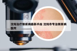 沈陽治療銀屑病最新手段 沈陽市專治銀屑病醫(yī)院