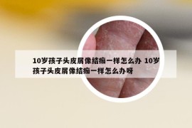10歲孩子頭皮屑像結痂一樣怎么辦 10歲孩子頭皮屑像結痂一樣怎么辦呀