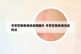 尋常型銀屑病消退期圖片 尋常型銀屑病消退特點(diǎn)