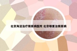 北京海淀治療銀屑病醫(yī)院 北京哪里治銀屑病