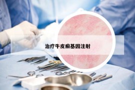 治療牛皮癬基因注射
