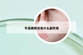 牛皮癬照光有什么副作用