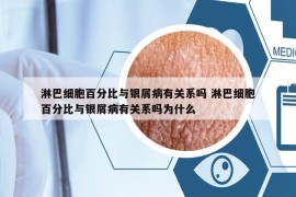 淋巴細胞百分比與銀屑病有關(guān)系嗎 淋巴細胞百分比與銀屑病有關(guān)系嗎為什么