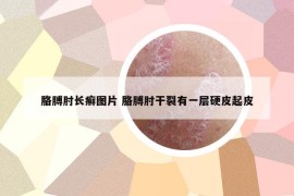 胳膊肘長(zhǎng)癬圖片 胳膊肘干裂有一層硬皮起皮