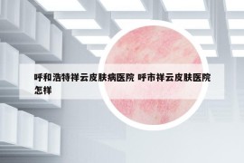呼和浩特祥云皮膚病醫(yī)院 呼市祥云皮膚醫(yī)院怎樣