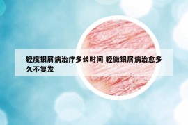 輕度銀屑病治療多長(zhǎng)時(shí)間 輕微銀屑病治愈多久不復(fù)發(fā)