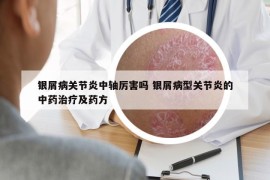 銀屑病關(guān)節(jié)炎中軸厲害嗎 銀屑病型關(guān)節(jié)炎的中藥治療及藥方