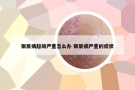 銀屑病超級嚴(yán)重怎么辦 銀屑病嚴(yán)重的癥狀