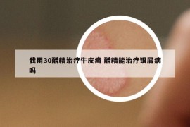 我用30醋精治療牛皮癬 醋精能治療銀屑病嗎
