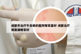 成都市治療牛皮癬的醫(yī)院哪家最好 成都治療銀屑病哪家好