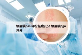 銀屑病pasi評分輕度幾分 銀屑病pga評分