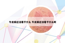 牛皮癬還活著干什么 牛皮癬還活著干什么呢