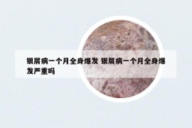 銀屑病一個(gè)月全身爆發(fā) 銀屑病一個(gè)月全身爆發(fā)嚴(yán)重嗎