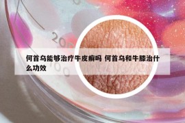何首烏能夠治療牛皮癬嗎 何首烏和牛膝治什么功效