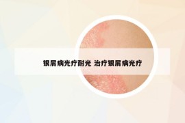 銀屑病光療耐光 治療銀屑病光療