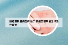 膿瘡型銀屑病怎樣治療 膿瘡型銀屑病怎樣治療最好